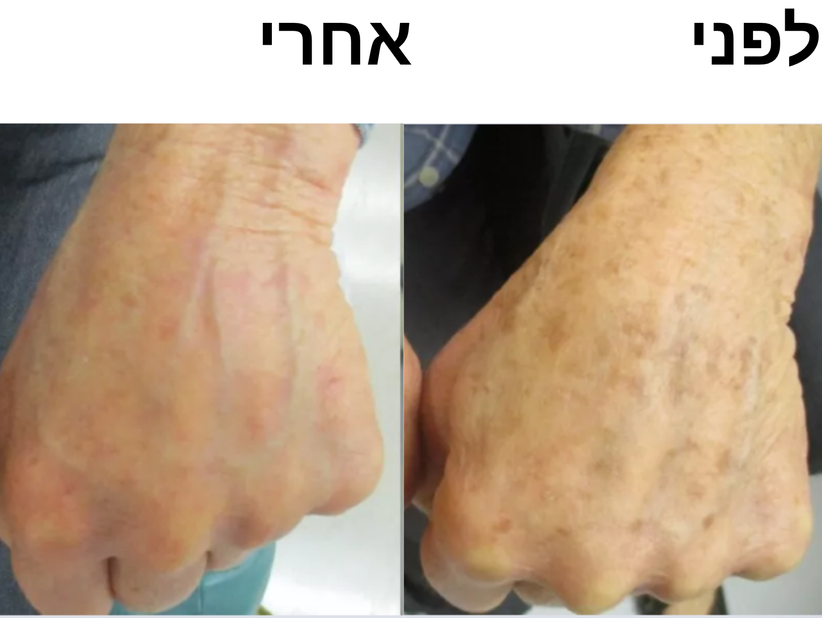 סבון סופרפוד לחיסול הכהויות בעור