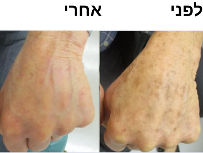 סבון סופרפוד לחיסול הכהויות בעור